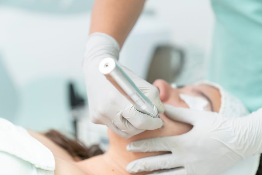 Microneedling-Behandlung mit Dermapen